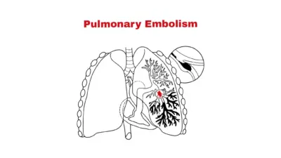 Understanding Pulmonary Embolism: Causes, Symptoms, and Treatment