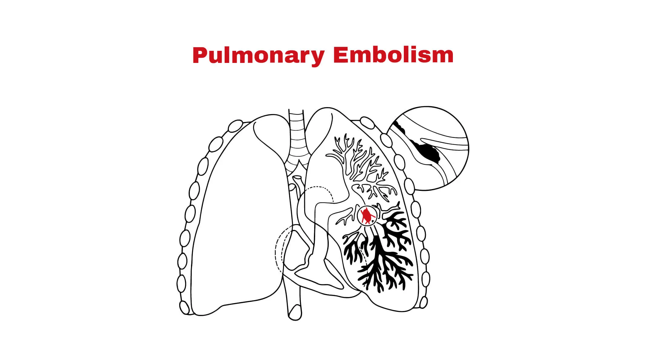 Understanding Pulmonary Embolism: Causes, Symptoms, and Treatment